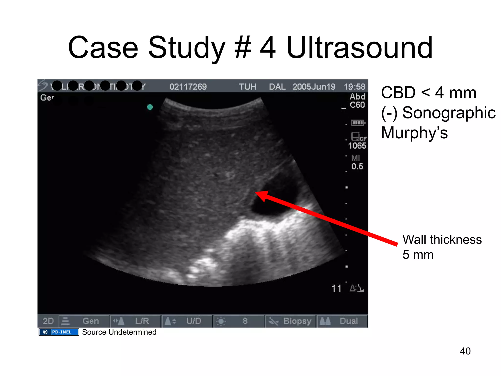 Case Study # 4 Ultrasound 
● ● ● ● ● ● ● ● ● _ 
CBD < 4 mm (-) Sonographic Murphy’s 
Wall thickness 5 mm 
40 
Source Undetermined  