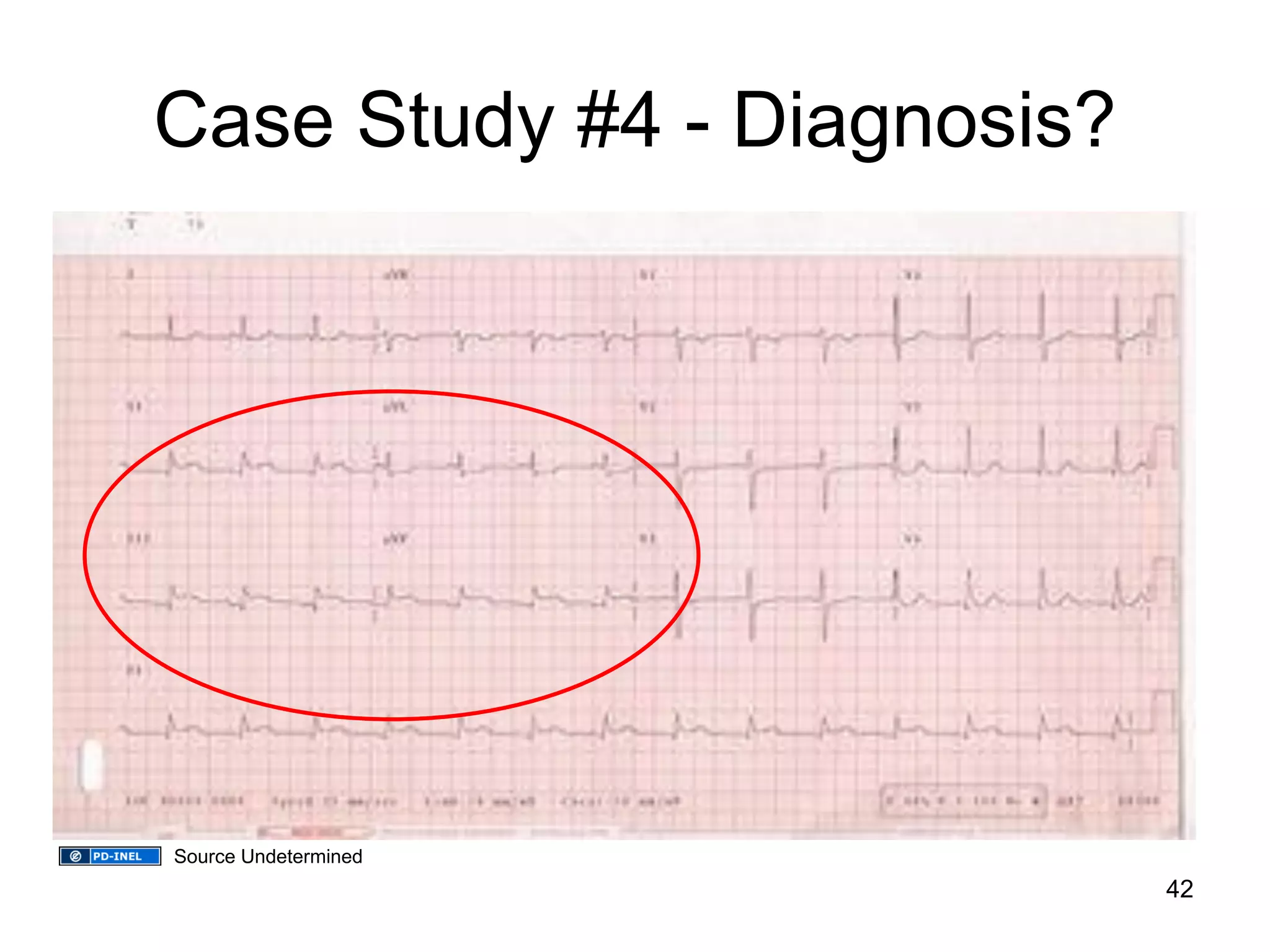 Case Study #4 - Diagnosis? 
42 
Source Undetermined  