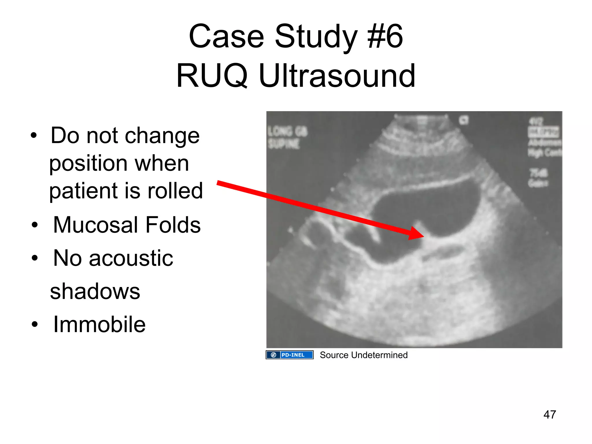 Case Study #6 RUQ Ultrasound 
•Mucosal Folds 
•No acoustic 
shadows 
•Immobile 
• Do not change position when patient is rolled 
47 
Source Undetermined  
