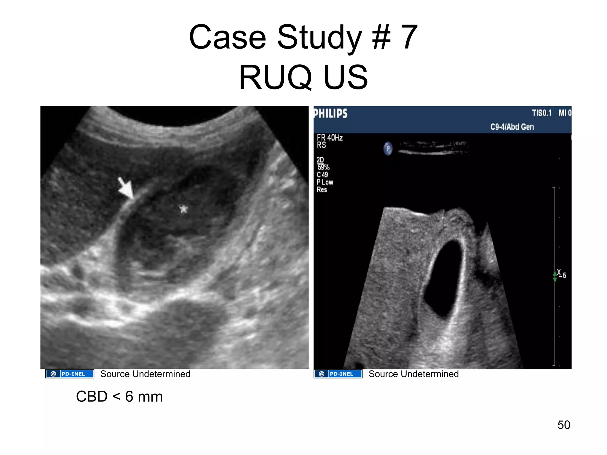 Case Study # 7 RUQ US 
CBD < 6 mm 
50 
Source Undetermined 
Source Undetermined  