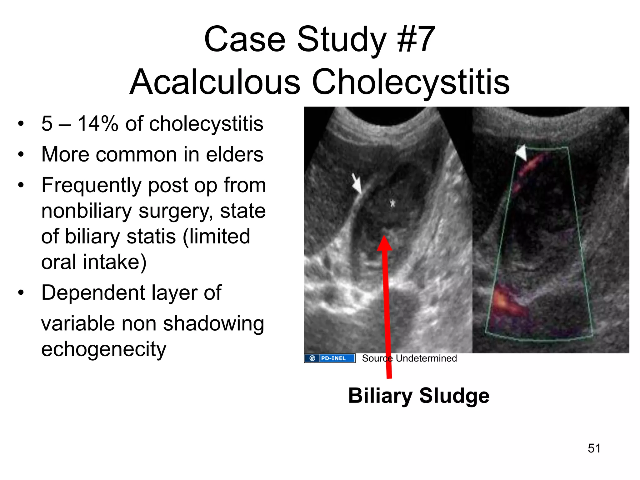 Case Study #7 Acalculous Cholecystitis 
•5 – 14% of cholecystitis 
•More common in elders 
•Frequently post op from nonbiliary surgery, state of biliary statis (limited oral intake) 
•Dependent layer of 
variable non shadowing echogenecity 
Biliary Sludge 
51 
Source Undetermined  