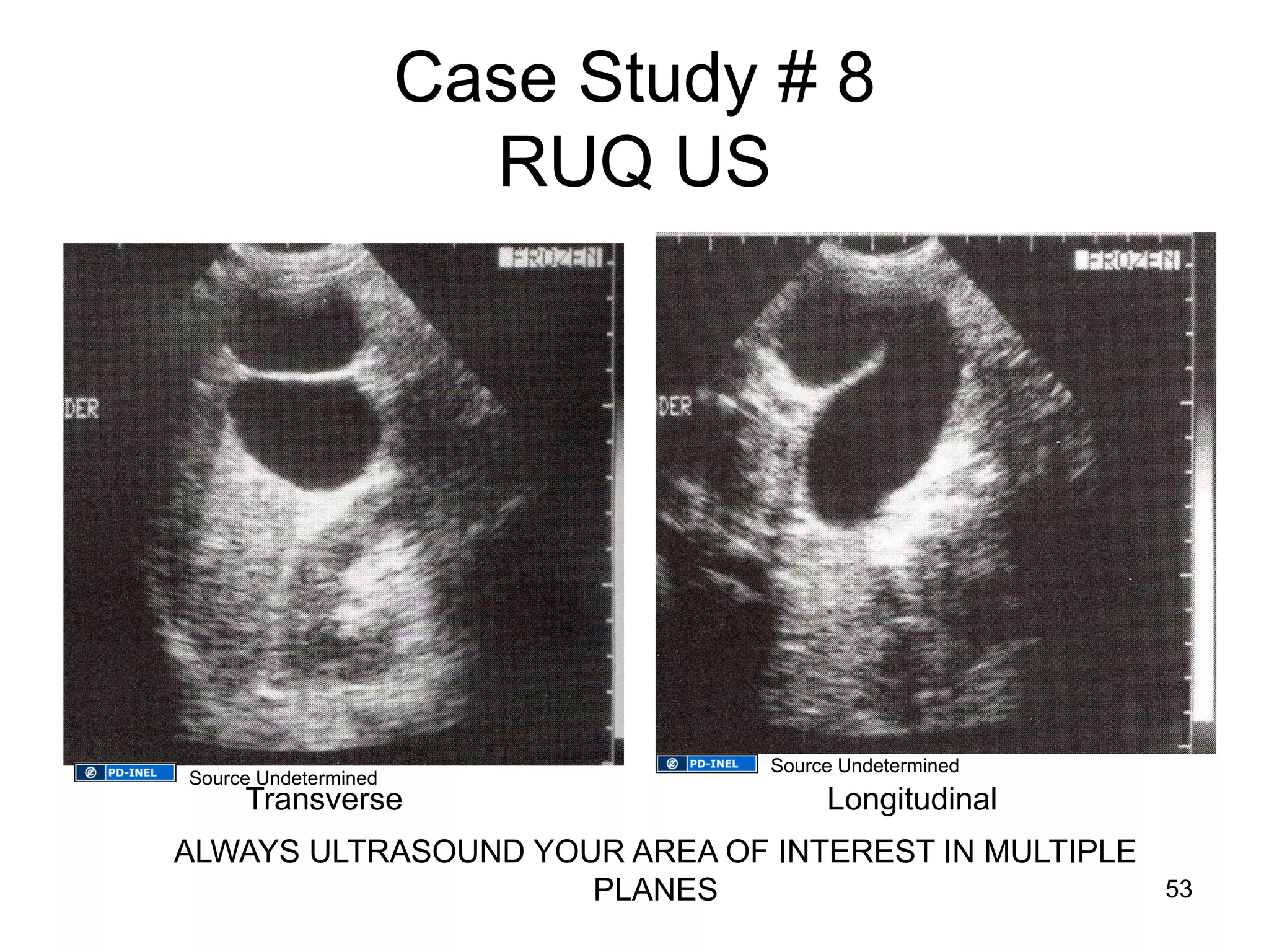 Case Study # 8 RUQ US 
Transverse 
Longitudinal 
ALWAYS ULTRASOUND YOUR AREA OF INTEREST IN MULTIPLE PLANES 
53 
Source Undetermined 
Source Undetermined  