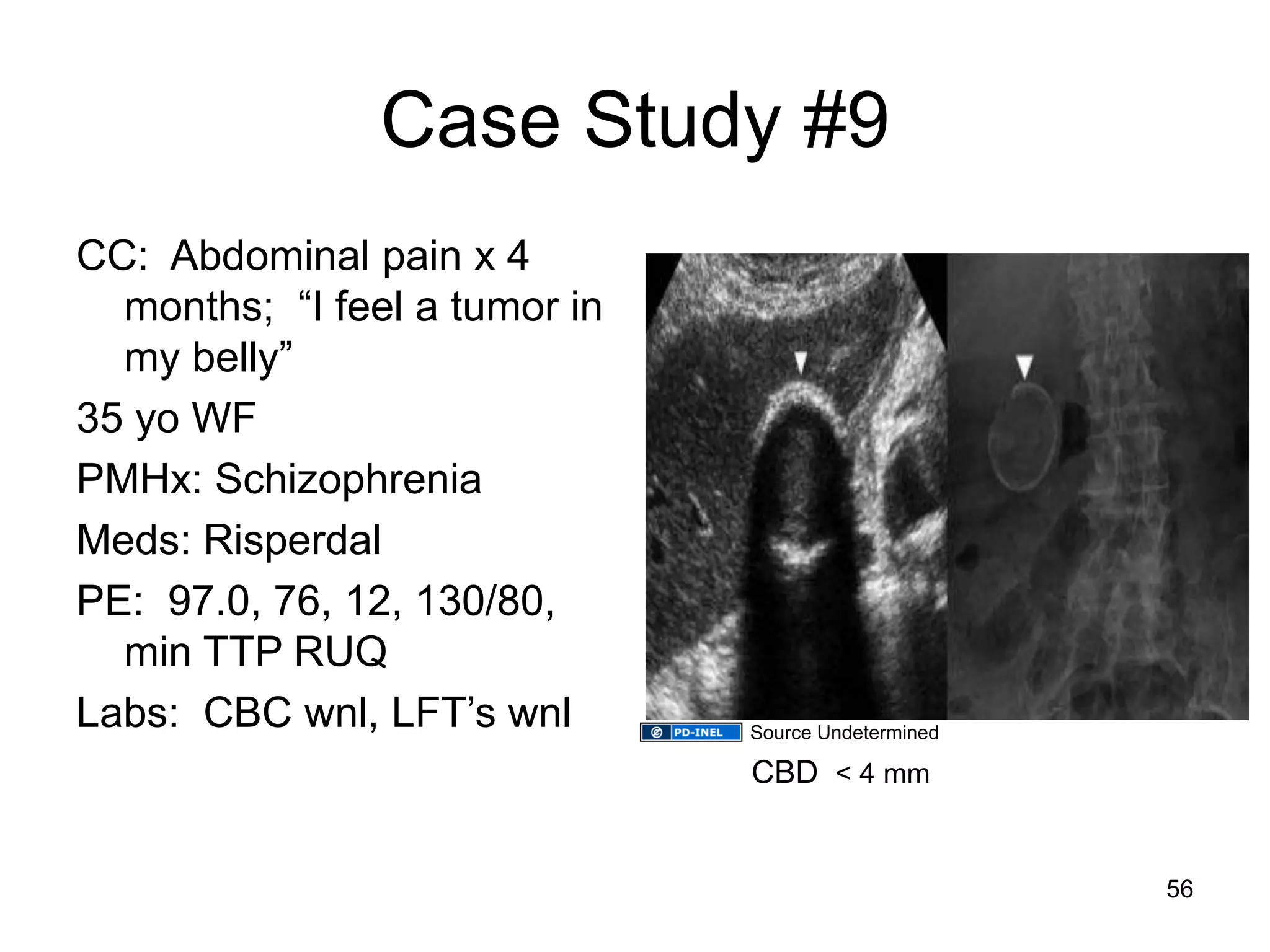 Case Study #9 
CC: Abdominal pain x 4 months; “I feel a tumor in my belly” 
35 yo WF 
PMHx: Schizophrenia 
Meds: Risperdal 
PE: 97.0, 76, 12, 130/80, min TTP RUQ 
Labs: CBC wnl, LFT’s wnl 
CBD < 4 mm 
56 
Source Undetermined  