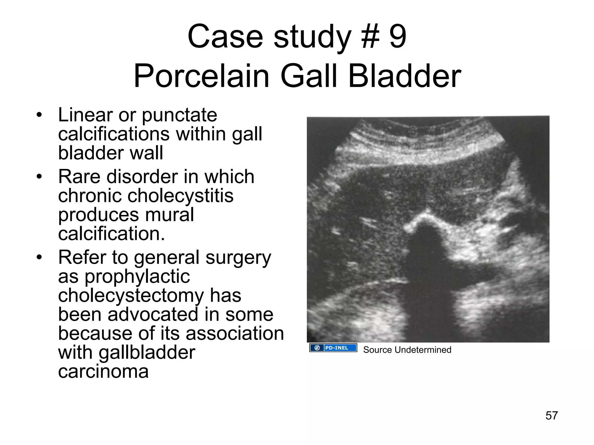 Case study # 9 Porcelain Gall Bladder 
•Linear or punctate calcifications within gall bladder wall 
•Rare disorder in which chronic cholecystitis produces mural calcification. 
•Refer to general surgery as prophylactic cholecystectomy has been advocated in some because of its association with gallbladder carcinoma 
57 
Source Undetermined  