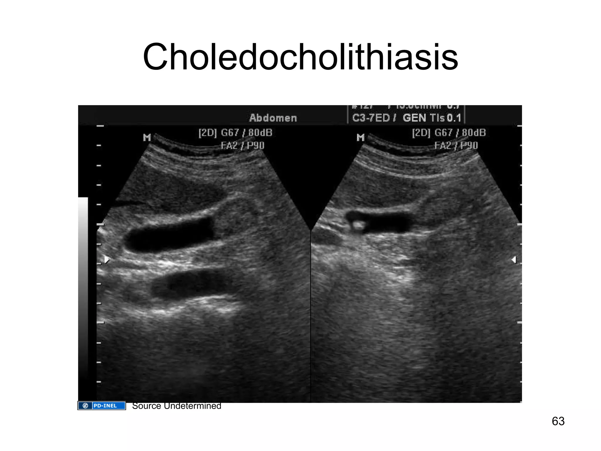 Choledocholithiasis 
63 
Source Undetermined 
 