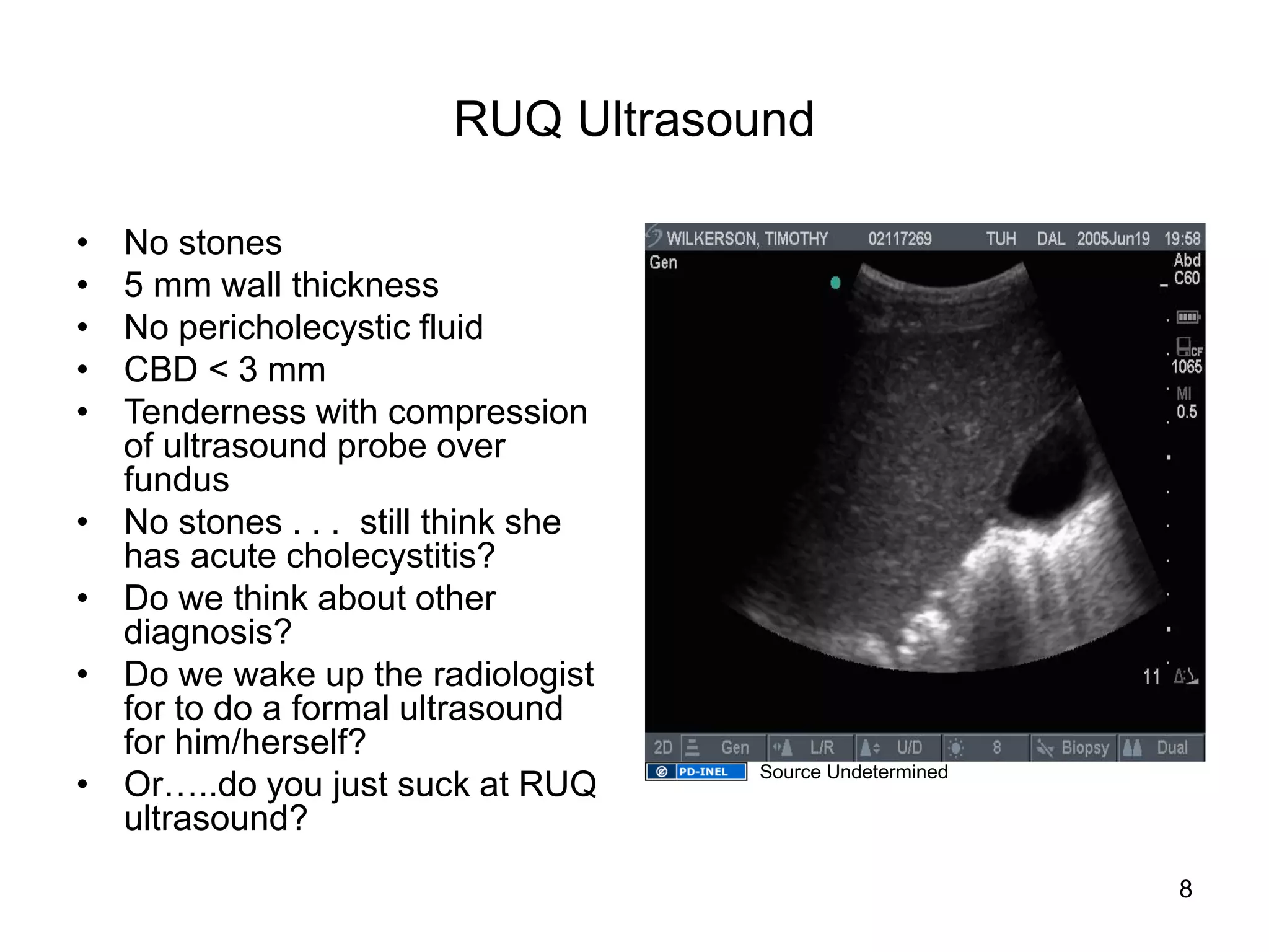 RUQ Ultrasound 
•No stones 
•5 mm wall thickness 
•No pericholecystic fluid 
•CBD < 3 mm 
•Tenderness with compression of ultrasound probe over fundus 
•No stones . . . still think she has acute cholecystitis? 
•Do we think about other diagnosis? 
•Do we wake up the radiologist for to do a formal ultrasound for him/herself? 
•Or…..do you just suck at RUQ ultrasound? 
8 
Source Undetermined  