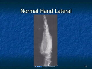 Normal Hand Rentgen GEMC: Radiology: X-rays of the Hand and Wrist: Resident Training | PDF