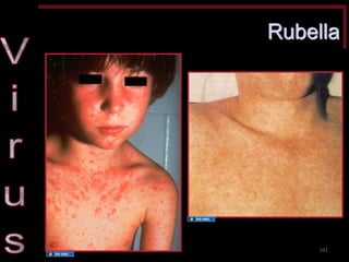 Rubella 
101 
Source Undetermined 
Source Undetermined  
