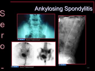 Ankylosing Spondylitis 
110 
Source Undetermined 
Source Undetermined 
Source Undetermined  