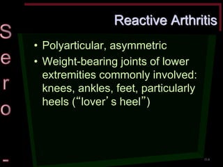 Reactive Arthritis •Polyarticular, asymmetric •Weight-bearing joints of lower extremities commonly involved: knees, ankles, feet, particularly heels (“lover’s heel”) 
114  