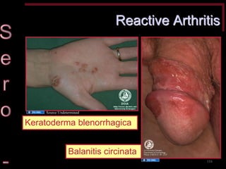 Reactive Arthritis 
Keratoderma blenorrhagica 
Balanitis circinata 
116 
Source Undetermined 
Source Undetermined  