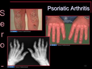 Psoriatic Arthritis 
122 
Source Undetermined 
Source Undetermined 
Source Undetermined  