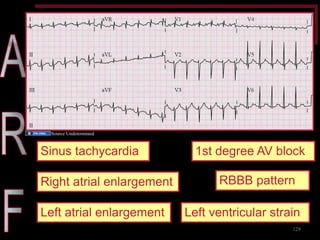 Diagnosis – Jones Criteria 
Sinus tachycardia 
Right atrial enlargement 
Left atrial enlargement 
Left ventricular strain 
RBBB pattern 
1st degree AV block 
128 
Source Undetermined  