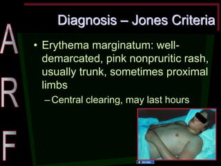 Diagnosis – Jones Criteria •Erythema marginatum: well- demarcated, pink nonpruritic rash, usually trunk, sometimes proximal limbs –Central clearing, may last hours 
129 
Source Undetermined  