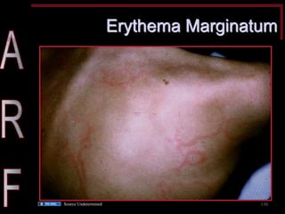 Erythema Marginatum 
130 
Source Undetermined  