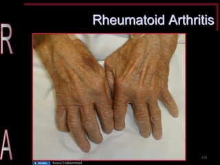 Rheumatoid Arthritis 
134 
Source Undetermined  
