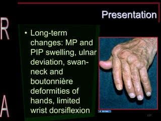 Presentation •Long-term changes: MP and PIP swelling, ulnar deviation, swan- neck and boutonnière deformities of hands, limited wrist dorsiflexion 
137 
Source Undetermined  