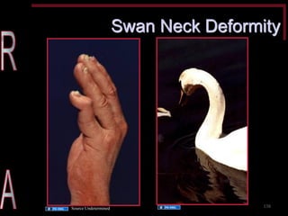 Swan Neck Deformity 
138 
Source Undetermined 
Source Undetermined  