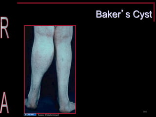 Baker’s Cyst 
140 
Source Undetermined  