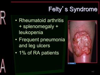 Felty’s Syndrome •Rheumatoid arthritis + splenomegaly + leukopenia •Frequent pneumonia and leg ulcers •1% of RA patients 
142 
Source Undetermined  