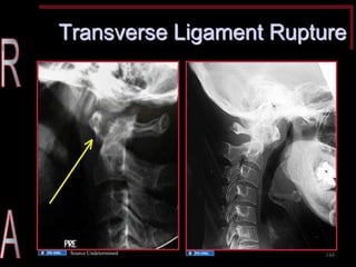 Transverse Ligament Rupture 
144 
Source Undetermined 
Source Undetermined  