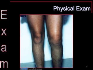 Physical Exam 
Source Undetermined 
24  