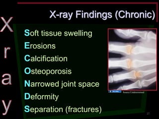 X-ray Findings (Chronic) Soft tissue swelling Erosions Calcification Osteoporosis Narrowed joint space Deformity Separation (fractures) 
Source Undetermined 
27  