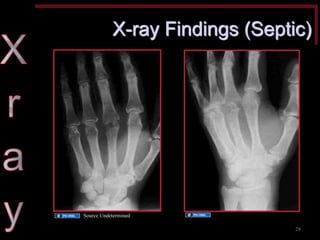 X-ray Findings (Septic) 
Source Undetermined 
Source Undetermined 
28  