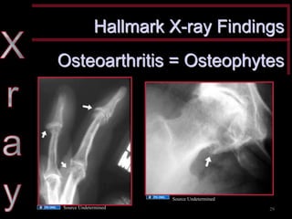 Hallmark X-ray Findings 
Osteoarthritis = Osteophytes 
Source Undetermined 
Source Undetermined 
29  
