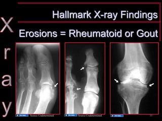 Hallmark X-ray Findings 
Erosions = Rheumatoid or Gout 
Source Undetermined 
Source Undetermined 
Source Undetermined 
30  