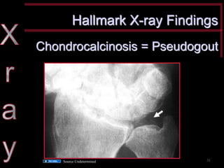 Hallmark X-ray Findings 
Chondrocalcinosis = Pseudogout 
Source Undetermined 
31  