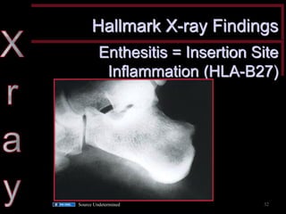 Hallmark X-ray Findings 
Enthesitis = Insertion Site Inflammation (HLA-B27) 
Source Undetermined 
32  
