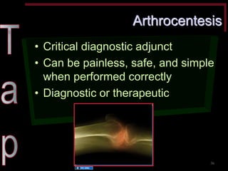 Arthrocentesis •Critical diagnostic adjunct •Can be painless, safe, and simple when performed correctly •Diagnostic or therapeutic 
Source Undetermined 
36  