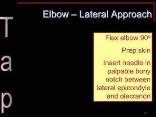 Elbow – Lateral Approach 
Flex elbow 90o Prep skin Insert needle in palpable bony notch between lateral epicondyle and olecranon 
44  