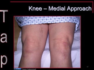 Knee – Medial Approach 
47 
Source Undetermined  