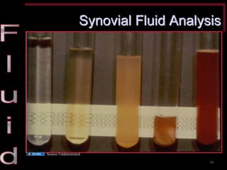 Synovial Fluid Analysis 
54 
Source Undetermined  