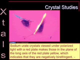 Crystal Studies 
Sodium urate crystals viewed under polarized light with a red plate makes those in the plane of the long axis of the red plate yellow, which indicates that they are negatively birefringent. 
60 
Source Undetermined  