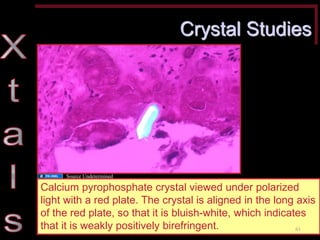 Crystal Studies 
Calcium pyrophosphate crystal viewed under polarized light with a red plate. The crystal is aligned in the long axis of the red plate, so that it is bluish-white, which indicates that it is weakly positively birefringent. 
61 
Source Undetermined  