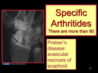 Specific Arthritides There are more than 90 
Preiser’s disease: avascular necrosis of scaphoid 
62 
Source Undetermined  
