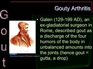 Gouty Arthritis •Galen (129-199 AD), an ex-gladiatorial surgeon in Rome, described gout as a discharge of the four humors of the body in unbalanced amounts into the joints (hence gout = gutta, a drop) 
72 
Pierre Roche Vigneron (Wikimedia Commons)  