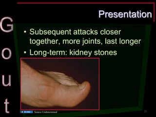 Presentation •Subsequent attacks closer together, more joints, last longer •Long-term: kidney stones 
77 
Source Undetermined  