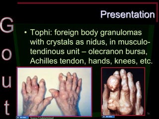 Presentation •Tophi: foreign body granulomas with crystals as nidus, in musculo- tendinous unit – olecranon bursa, Achilles tendon, hands, knees, etc. 
78 
Source Undetermined 
Source Undetermined  
