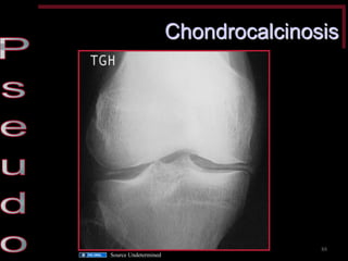 Chondrocalcinosis 
88 
Source Undetermined  
