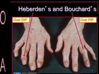 Heberden’s and Bouchard’s 
Over DIP 
Over PIP 
91 
Source Undetermined  