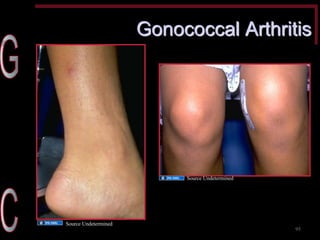 Gonococcal Arthritis 
95 
Source Undetermined 
Source Undetermined  