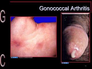 Gonococcal Arthritis 
96 
Source Undetermined 
Source Undetermined  