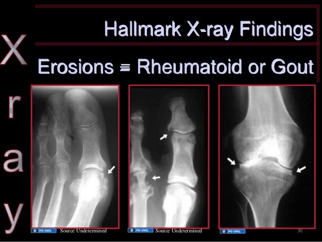 cellulitis of the finger #11