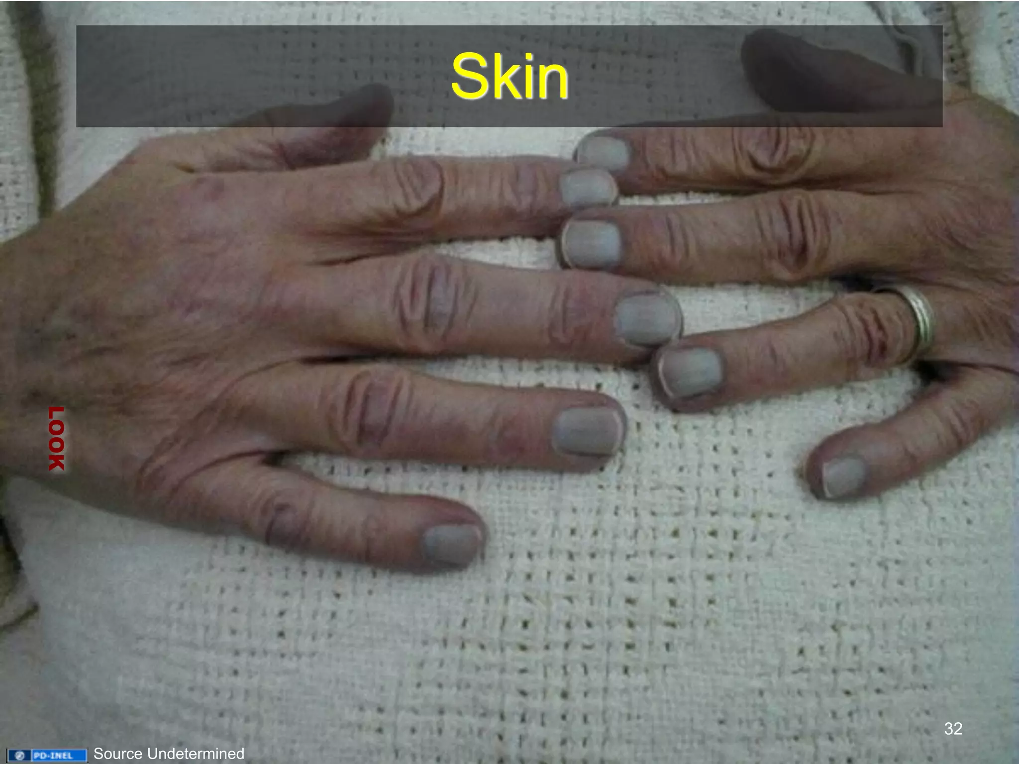 Skin 
LOOK 
32 
Source Undetermined 
 