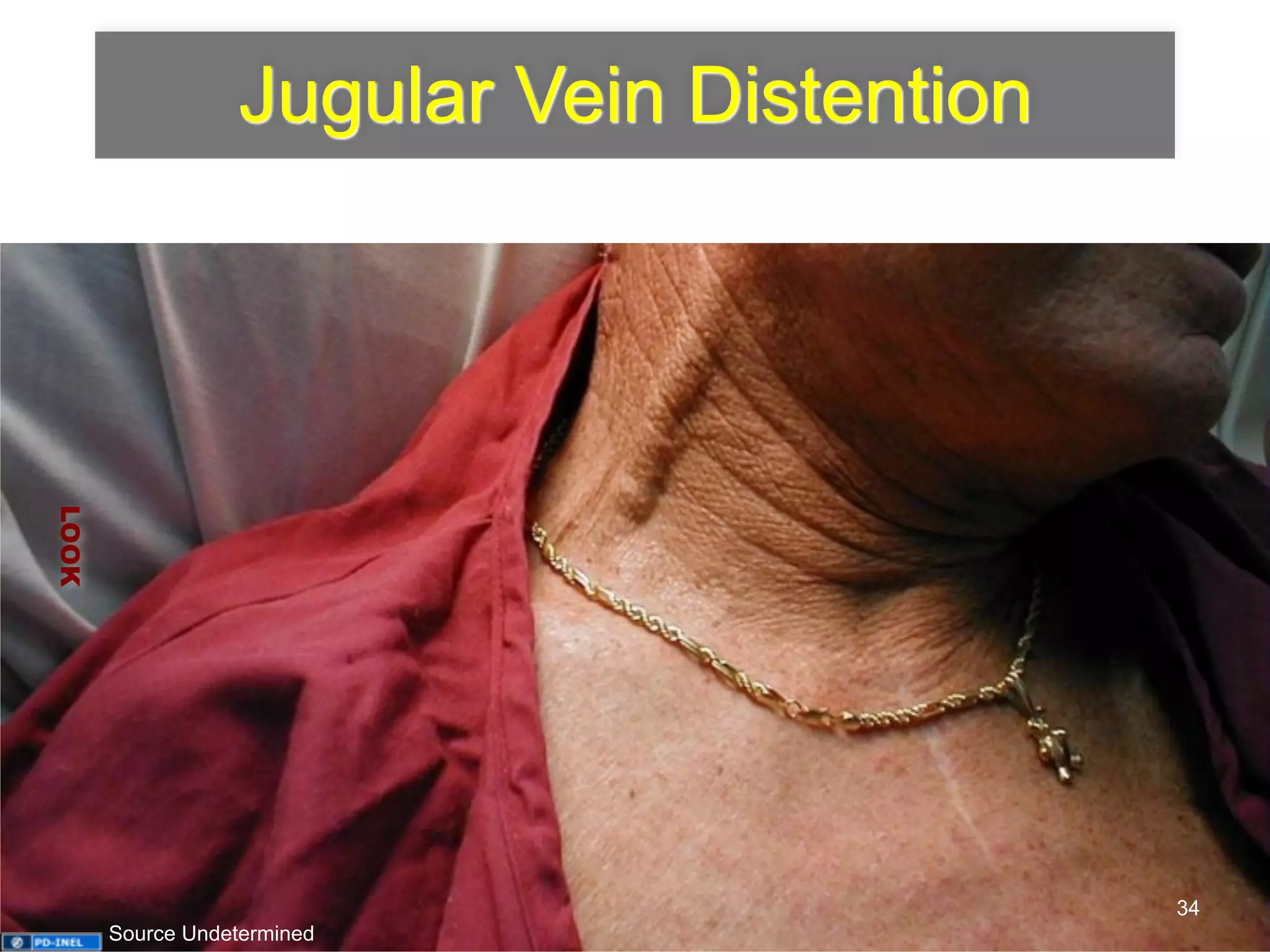 Jugular Vein Distention 
LOOK 
34 
Source Undetermined 
 