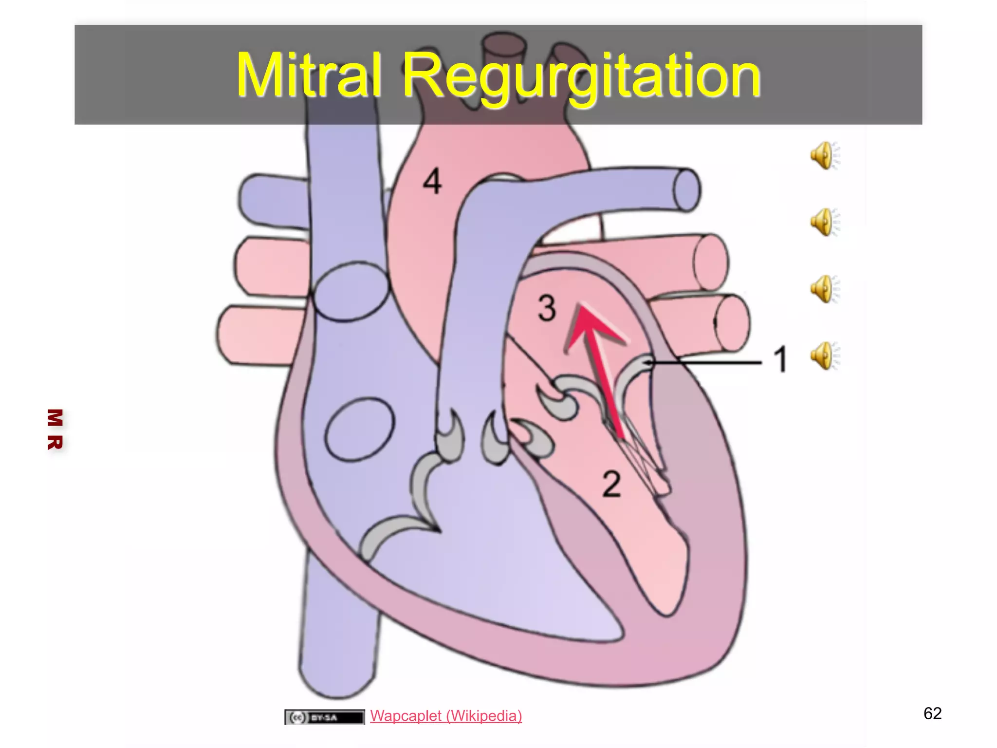 Mitral Regurgitation 
M R 
Wapcaplet (Wikipedia) 62 
 